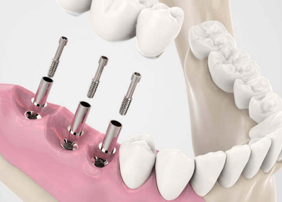 Studio Dentistico Colombotto | Implantologia
